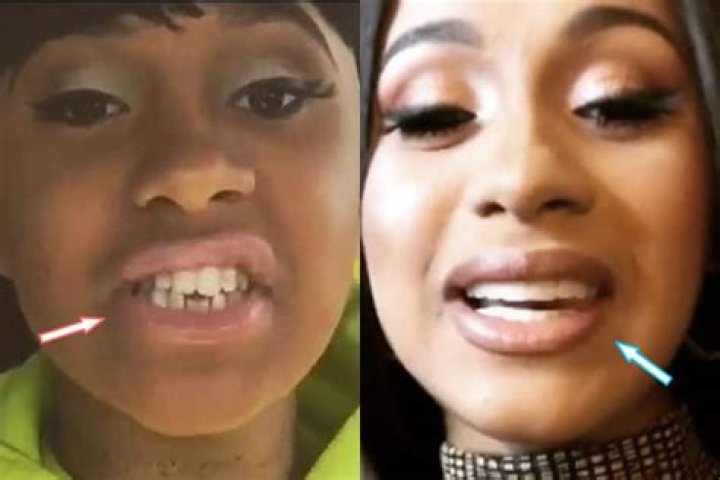 Cardi B Teeth Then And Now